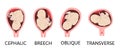 Different baby positions during pregnancy. Cephalic, Breech, transverse, Oblique lies. Colored medical vector illustration Royalty Free Stock Photo