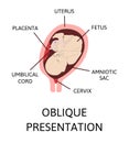 Different baby positions in the uterus during pregnancy