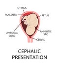 Different baby positions in the uterus during pregnancy