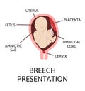 Different baby positions in the uterus during pregnancy Royalty Free Stock Photo