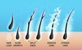 Different hair problems and deep salon treatment vector illustrations set, macro view of balding scalp skin and