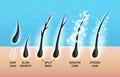 Different hair problems and deep salon treatment vector illustrations set, macro view of balding scalp skin and