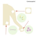 Different Items of Contraception and Birth Control Royalty Free Stock Photo