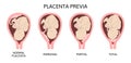 Different Placental Locations During Pregnancy. Major and Normal placenta previa, total and partial.