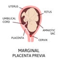 Different Placental Locations During Pregnancy. Major and Normal placenta previa, total and partial