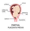 Different Placental Locations During Pregnancy. Major and Normal placenta previa, total and partial