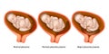 Different Placental Locations During Pregnancy