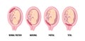 Different Placental Locations During Pregnancy. Normal, marginal, partial and total previa.