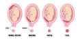 Different Placental Locations During Pregnancy. Normal, marginal, partial and total previa.