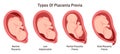 Different placental locations during pregnancy. Placenta previa