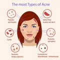 Different type of acne. Vector Illustration with skin problems. Royalty Free Stock Photo