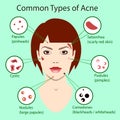 Different type of acne. Vector Illustration with skin problems. woman face isolated Royalty Free Stock Photo