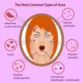 Different type of acne. Vector Illustration with skin problems. woman face isolated