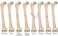 Bone fracture types medical vector illustration