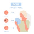 Different types of facial skin acne