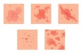 Different types of psoriasis vector set. Part of patients skin with dermatitis, inflammation, red rash and other skin