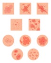 Different types of psoriasis vector set. Part of patients skin with dermatitis, inflammation, red rash and other skin