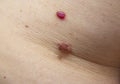Different types of skin moles tags