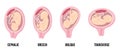 Different wrong baby positions in uterus during pregnancy. Cephalic, Breech, transverse, Oblique lies.