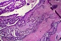 Differentiated intestinal adenocarcinoma, light micrograph Royalty Free Stock Photo