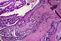 Differentiated intestinal adenocarcinoma, light micrograph