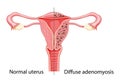 Diffuse Adenomyosis Human anatomy reproductive. Female Sick system vs versus normal, Compared educational healthy icon