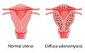 Diffuse Adenomyosis Human anatomy Female Sick vs normal reproductive system organs. Location Cross section scheme uterus