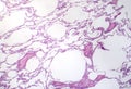 Diffuse emphysema, light micrograph