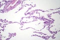 Diffuse emphysema, light micrograph