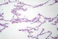Diffuse emphysema, light micrograph