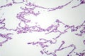 Diffuse emphysema, light micrograph