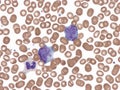 Diffuse large B-cell lymphoma in perpheral blood.
