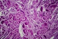 Diffuse proliferative glomerulonephritis