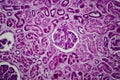 Diffuse proliferative glomerulonephritis