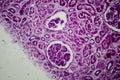 Diffuse proliferative glomerulonephritis