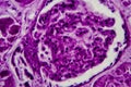 Diffuse proliferative glomerulonephritis