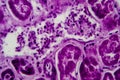 Diffuse proliferative glomerulonephritis