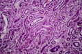 Diffuse proliferative glomerulonephritis