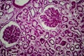 Diffuse sclerosing glomerulonephritis Royalty Free Stock Photo