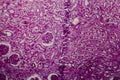 Diffuse sclerosing glomerulonephritis Royalty Free Stock Photo