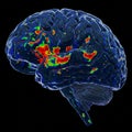 A digital rendering of a human brain depicts neural activity using color gradients.