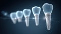 Digital wireframe dental implants displayed in a gradient mesh style against a Royalty Free Stock Photo