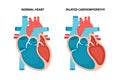 Dilated cardiomyopathy with cross-section view. Human heart muscle diseases. Cardiology concept.