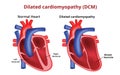 Dilated cardiomyopathy, Heart disease, Vector image Royalty Free Stock Photo