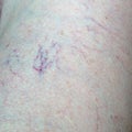 dilation of small blood vessels of the skin on the leg..