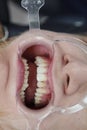 Dilator for the oral cavity. Preparation of the patient`s oral cavity for the installation of braces. Macro photo. Unrecognizable