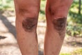 Dirty knees in an adult woman, close-up, in the camp, on a blurred background.