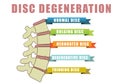Disc degeneration diagram with condition exampes - bulging, hernoated, degenerative and thinning disc. Educational medical