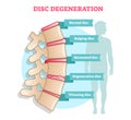 Disc degeneration flat illustration vector diagram with condition exampes - bulging, hernoated, degenerative and thinning disc. Ed Royalty Free Stock Photo