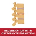 Disc degeneration with osteophyte formation Royalty Free Stock Photo